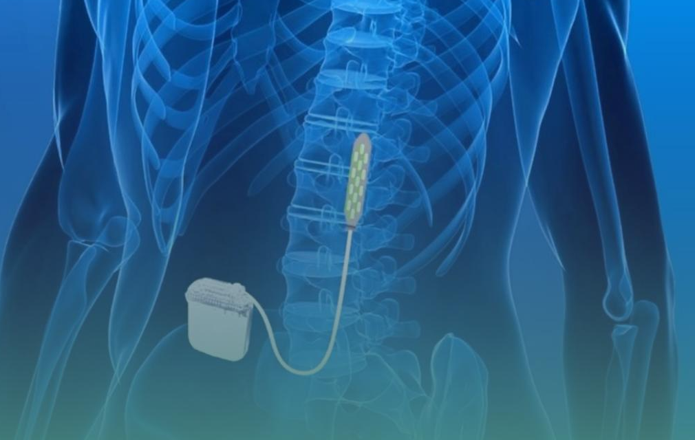 Neuroestimulação medular e tratamento da dor crônica