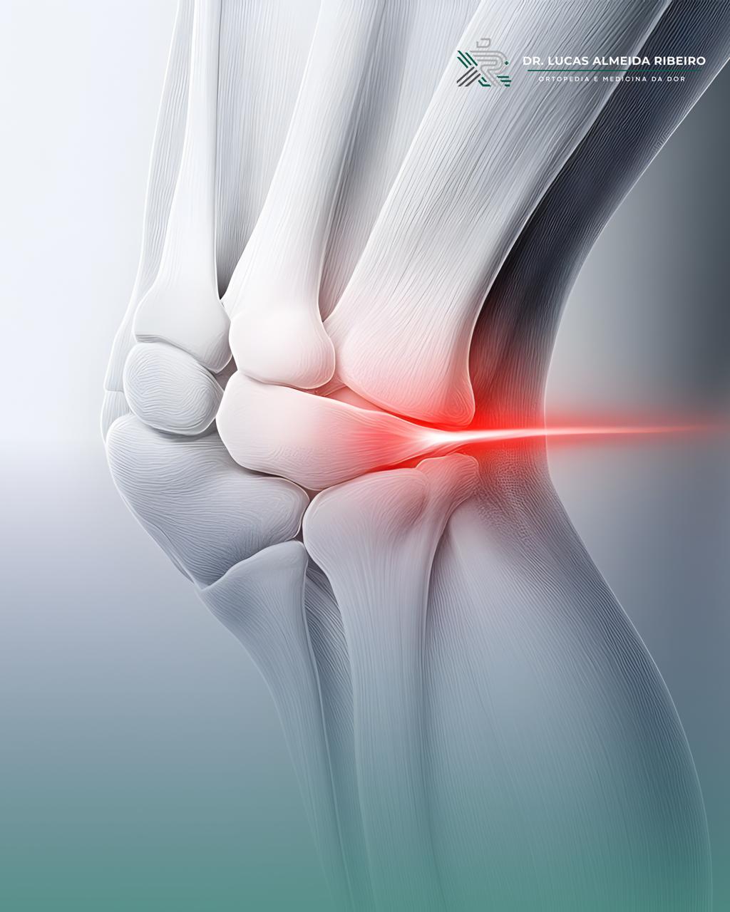 Ortobiológicos na artrose de joelho com PRP